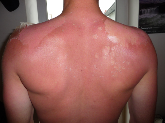 sunburn and my spray tan