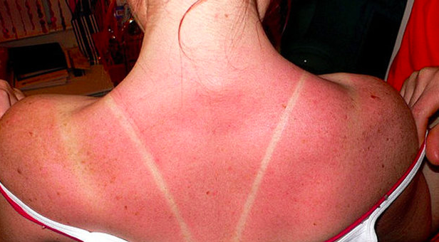 Sun burn and my spray tan